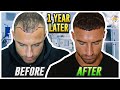 My Hair Transplant Results After 1 Year