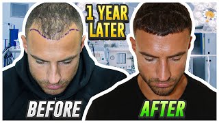 My Hair Transplant Results After 1 Year
