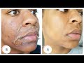 I GOT A CHEMICAL PEEL ! Full Process + Results | Remove Dark Marks, Enlarged Pores & Wrinkles