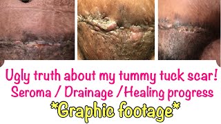 Why your tummy tuck scar is not healing! | Seroma not healing | Healing process of tummy tuck scar!