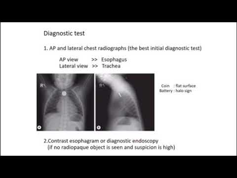 common anomalies of esophagus and EA-TEF