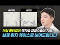 “가슴확대수술로 동시에 짝가슴 교정까지 가능하다고?!” 실제 환자 케이스로 보는 짝가슴 교정 리뷰!