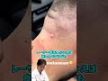 【うなじの埋没毛】針を使った埋没毛除去！たかし先生もあまりの長さに言葉を失う！