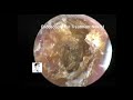 Ear Wax Removal,Management of fungi in the external auditory canal,11mins