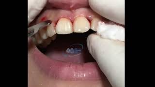 Circumferential Supracrestal  Fibrotomy | أفضل دكتور اسنان فى المنوفية