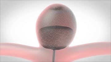 WEB : Woven Endobridge Device