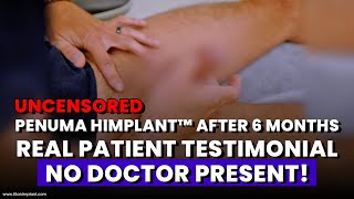 Amazing 6month Honest Penuma Implant Review  Real Patients Testimonial Without A Doctor Present