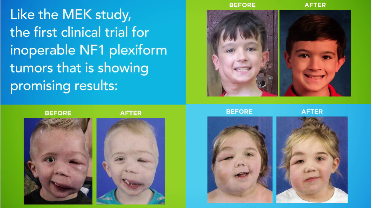 May is NF (Neurofibromatosis) Awareness Month