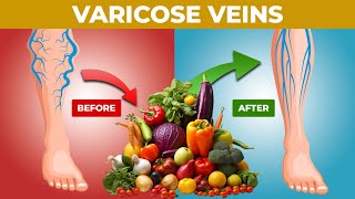 Powerful Foods to Fight Against Varicose Veins!