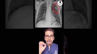 What is shown in Chest Xray? #pulmonology #radiology #xray