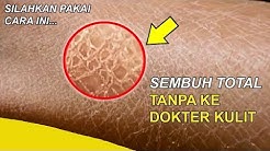 Dijamin Ampuh! Cara Mengobati  Kulit Bersisik Dengan Cepat Tanpa Ke Dokter Kulit - Durasi: 5.43. 