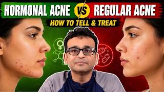 Hormonal Acne vs Regular Acne: How to Identify & Treat the Right Way | Dermatologist Explains