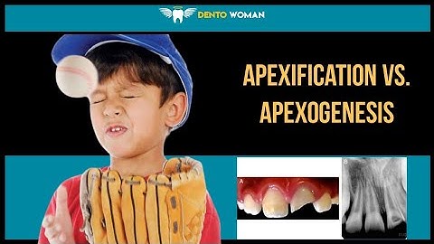 Apexification Vs. Apexogenesis #apexification #apexogenesis