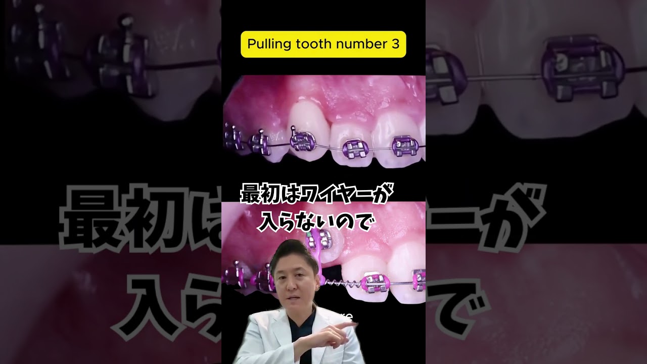 ゴムで埋まっている歯を引っ張っていきます！#歯列矯正 #dentist #矯正 #矯正歯科 #蒲田 #歯 #ワイヤー矯正