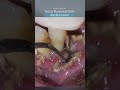 歯石除去ASMR Tartar Removal Only Part1 #ザホワイトデンタルクリニック #歯医者 #歯石除去 #歯石