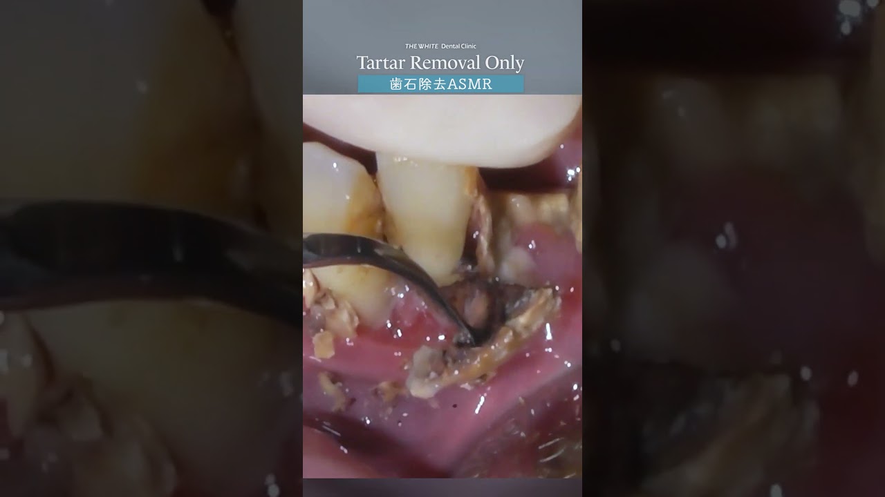 歯石除去ASMR Tartar Removal Only Part1 #ザホワイトデンタルクリニック #歯医者 #歯石除去 #歯石