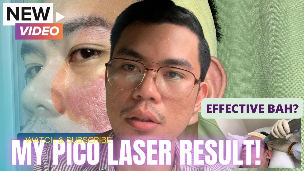 My Pico Laser Treatment Result – Before and After