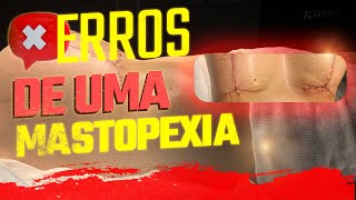 ERROS DE UMA MASTOPEXIA - CIRURGIA PLÁSTICA