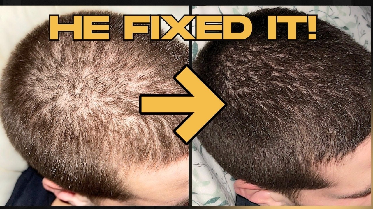 Финастерид ему не помог… Это всё исправило