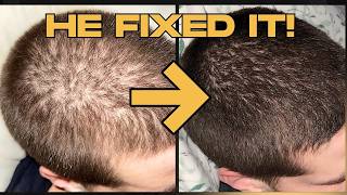 RU58841 vs Finasteride: He Switched and Grew It Back