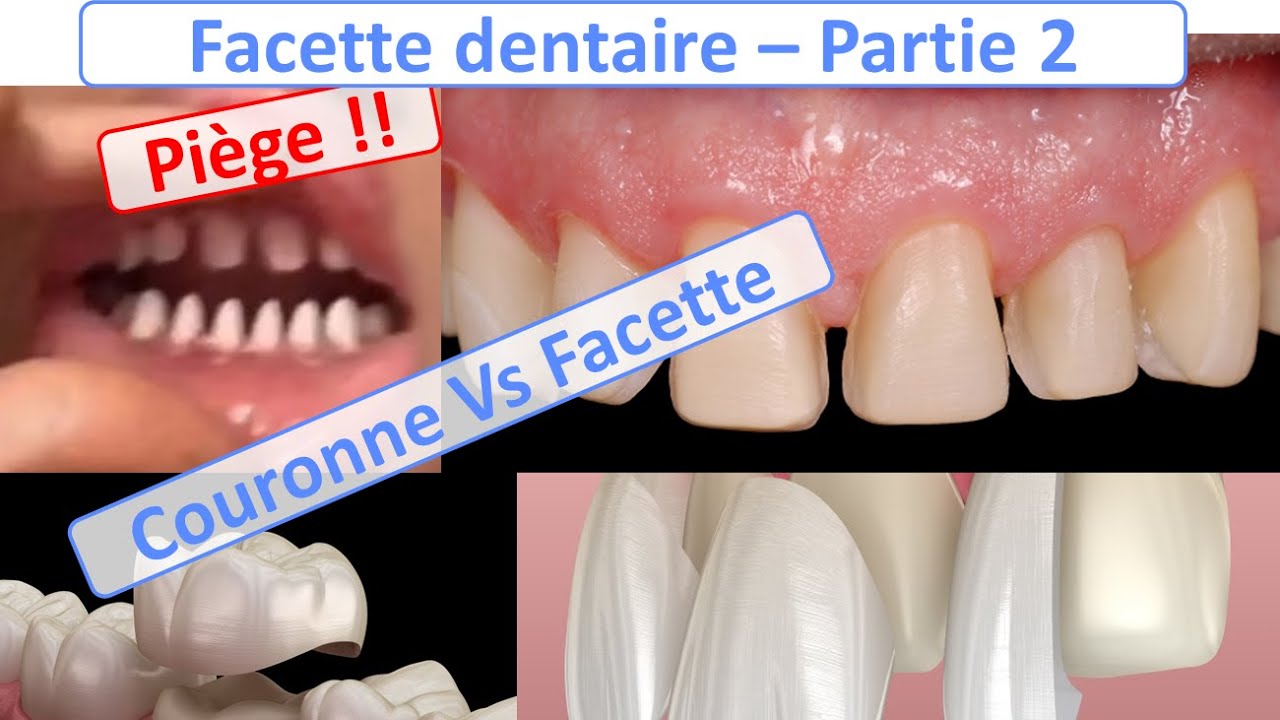 Facette Dentaire : Le Guide Complet Par Dr. Zisserman