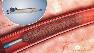 See how the Pounce™ Thrombectomy System works