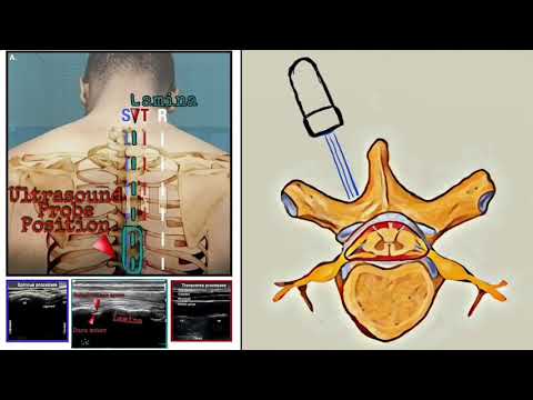 Thoracic Epidural US Assisted  POCUS MOSCOW Approach УЗИ ассистированный грудной эпидуральный блок