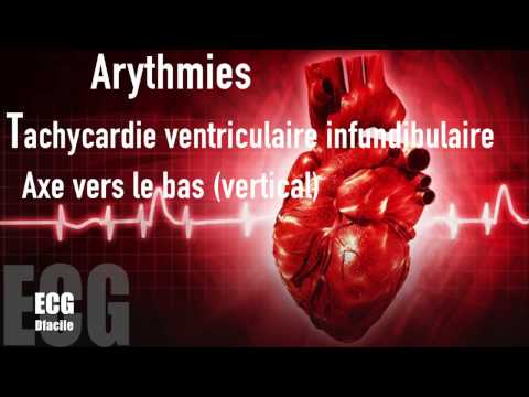 Vidéo: Qu'est-ce que la tachycardie ventriculaire fasciculaire ?