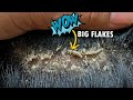 Removing Huge Dandruff Flakes!! Dandruff Removal Satisfying #285