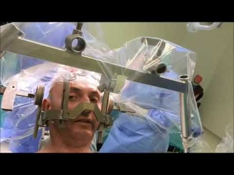 Селфи-Видео Операции по Имплантации Нейростимулятора Мозга при Болезни Паркинсона