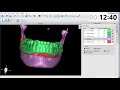 How 30 minutes could save you $3000 per arch on full arch implants