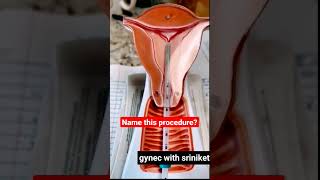 gynecology video || gynec amazing video || obs & gynec || IUCD
