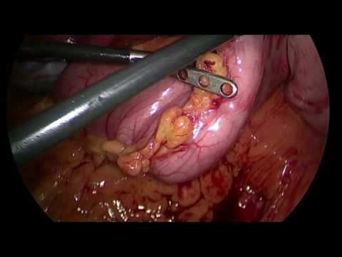 Video: Gastrectomia A Manica Verticale: Chirurgia Per Peso