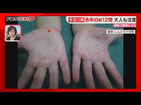 Hand, Foot, and Mouth Disease: Fukuoka at warning level for 6