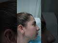 Get Youthful Looking Skin with Forehead Botox by Dr. Olivera Nikolic