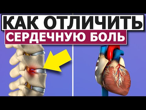 ОСТЕОХОНДРОЗ или СЕРДЦЕ | Что болит?