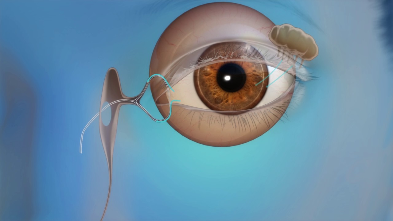 Blocked Tear Duct Treatment Through Oculoplastics Endoscopic DCR YouTube