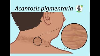 Acantosis pigmentaria
