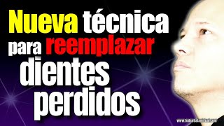 Todos Quieren Recuperar Sus Dientes Perdidos De Esta Nueva Manera