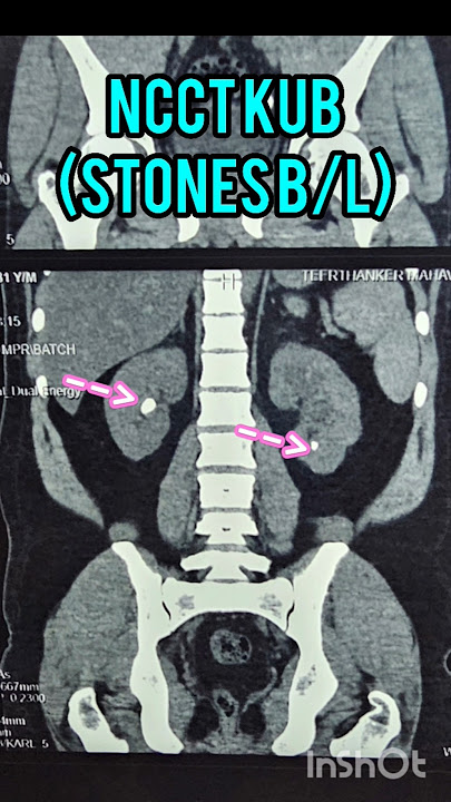 NCCT KUB SPOTTERS#58 / NEPHROLITHIASIS
