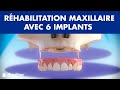 Réhabilitation du maxillaire avec 6 implants dentaires ©