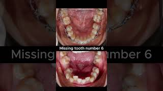 Missing tooth number 6 #braces  #orthodontist #niengrang