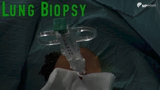 Lung biopsy screenshot 5