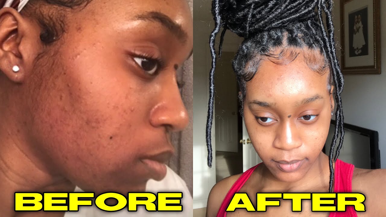 UNDERNEATH SKINCARE SKIN UPDATE AM I STILL USING UNDERNEATH SKINCARE
