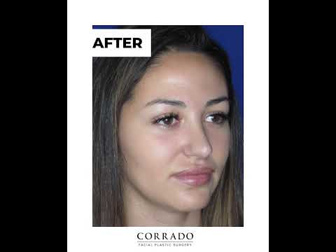 Video thumbnail: Bulbous Tip Rhinoplasty: Before & After Pictures | Dr. Anthony Corrado