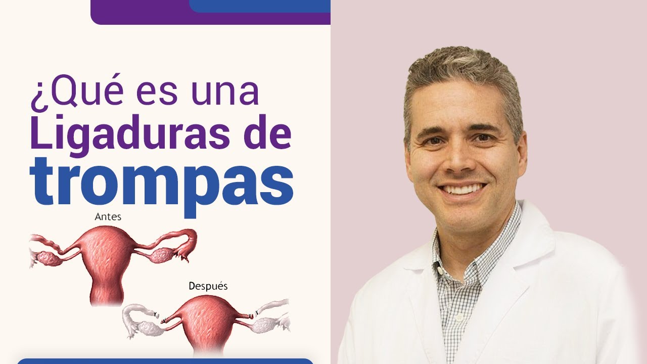 Qué es una ligadura de trompas l Dr. Juan Luis Giraldo YouTube