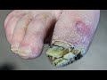 Whats growing on his foot thick skin or fungus