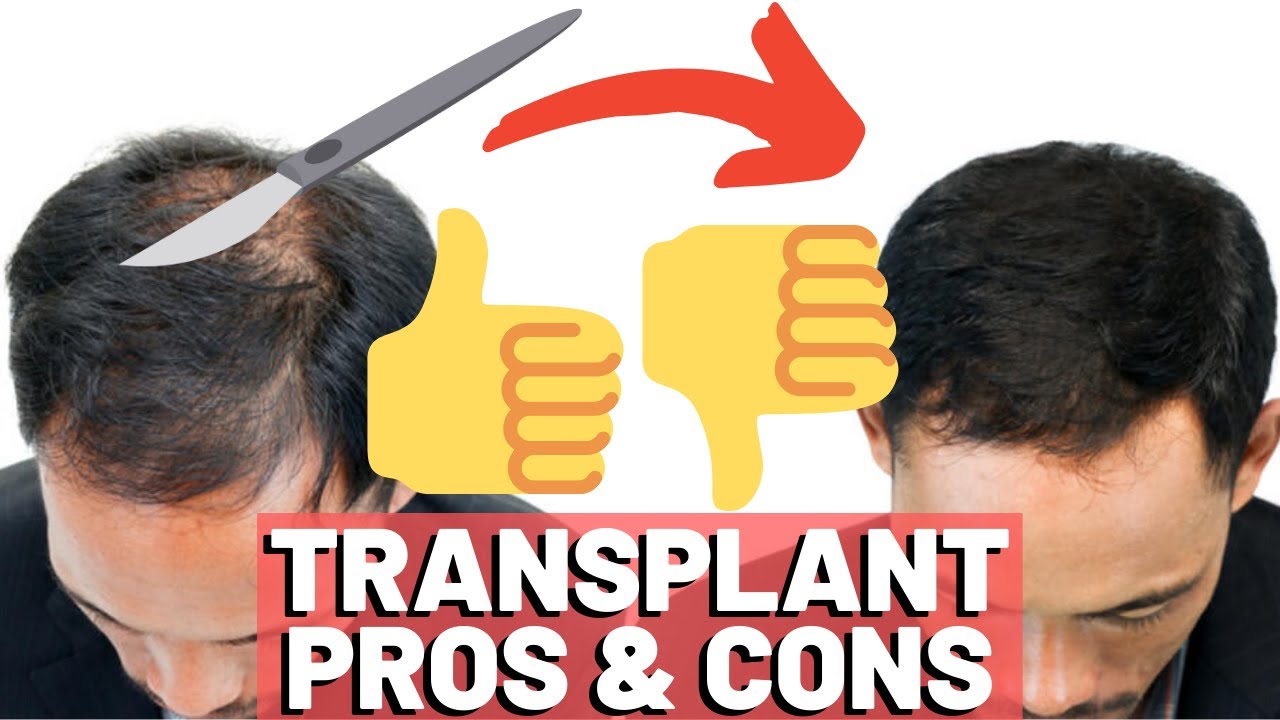 Hair Transplant PROS & CONS YouTube