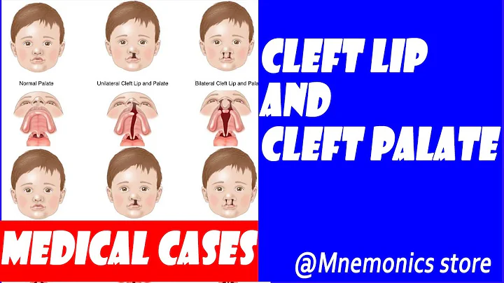CLEFT LIP AND CLEFT PALATE. TYPES/CAUSES/TREATMENT/PREVENTION. - DayDayNews