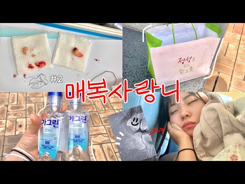 마지막 공포의 사랑니🦷 사랑니 발치 후기, 얼굴 안 붓는 꿀팁 | 마취주사💉, 치과, 실밥제거